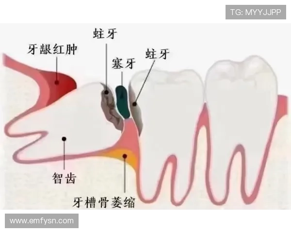 智齿：那些埋藏在牙龈深处的“人生”